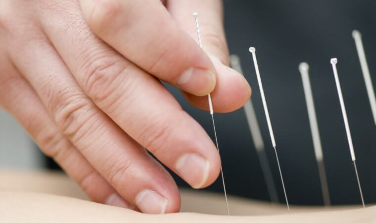 Akupunktur som smärtlindring ges av fysioterapeut eller arbetsterapeut hos Hälsa i Kubik i Mölndal